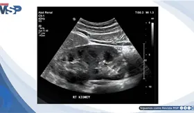 Edema, fatiga y menor producci&oacute;n de orina revelan enfermedad renal cr&oacute;nica estadio 4