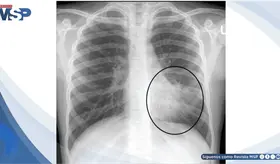 Taquipnea y baja oxigenaci&oacute;n: as&iacute; se present&oacute; un caso de neumon&iacute;a adquirida en la comunidad.