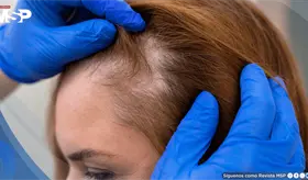 Un estudio identifica una prote&iacute;na clave para entender por qu&eacute; se genera la p&eacute;rdida de cabello