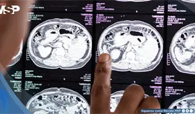 Estas son las se&ntilde;ales que pueden advertir un accidente cerebrovascular, cada minuto cuenta