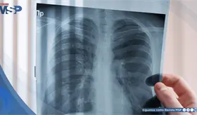 C&aacute;ncer de pulm&oacute;n: &iquest;por qu&eacute; tantos casos se detectan cuando ya est&aacute;n avanzados?