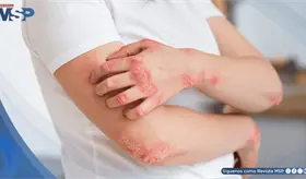 Psoriasis: lo que debe saber una persona que vive con esta enfermedad cr&oacute;nica