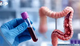 An&aacute;lisis de sangre para detectar c&aacute;ncer de colon: &iquest;una alternativa realmente eficaz?