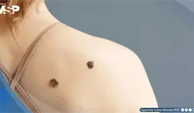 Moderna y Merck presentan resultados alentadores de una vacuna personalizada contra el melanoma