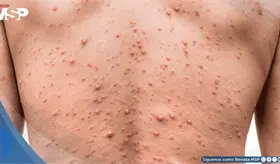 Viruela del mono: Argentina confirma 15 casos de mpox en lo que va de 2026