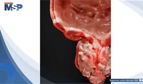 Carcinoma renal con trombo tumoral: una presentaci&oacute;n compleja documentada en Puerto Rico