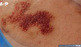 Vacuna contra el melanoma muestra resultados positivos en fase III, pero expertos piden cautela