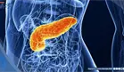 C&aacute;ncer de p&aacute;ncreas: FDA aprueba p&iacute;ldora que revoluciona el tratamiento contra esta enfermedad