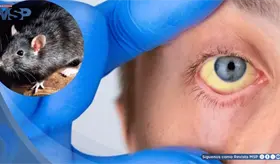 Fiebre, ictericia y lesión renal aguda tras exposición ambiental: una presentación grave de leptospirosis