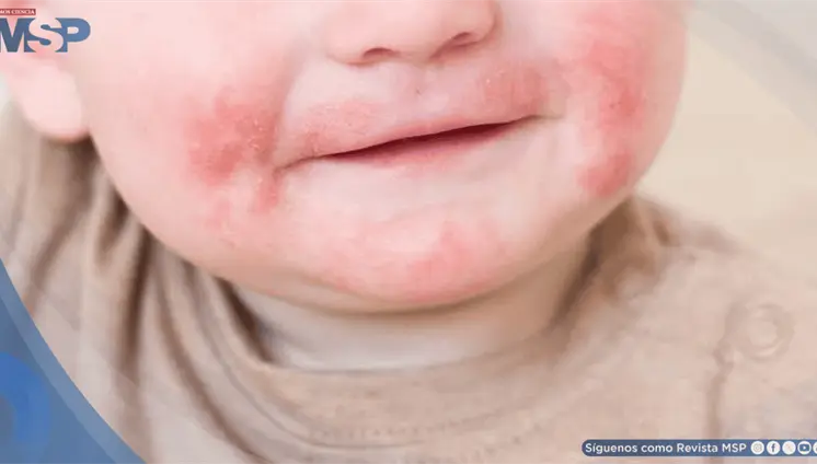 Dermatitis atópica, una enfermedad que afecta a recién nacidos y lactantes Dermatitis atópica, una enfermedad que afecta a recién nacidos y lactantes