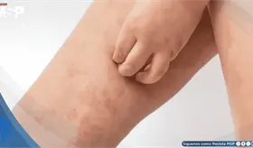 Dermatitis at&oacute;pica