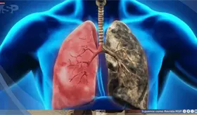 Enfermedad pulmonar obstructiva cr&oacute;nica en paciente fumador con exacerbaci&oacute;n respiratoria