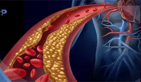 Las afecciones cerebrovasculares se pueden prevenir. Evite que su colesterol suba