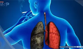 C&aacute;ncer de pulm&oacute;n en paciente con antecedente de tabaquismo cr&oacute;nico
