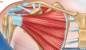 Tendinitis del manguito rotador