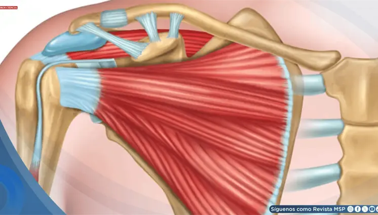 Tendinitis del manguito rotador Tendinitis del manguito rotador