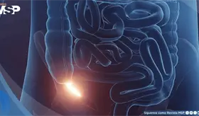 Apendicitis: Emergencia m&eacute;dica que requiere atenci&oacute;n inmediata