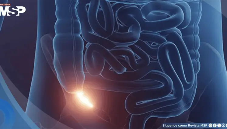 Apendicitis: Emergencia médica que requiere atención inmediata Apendicitis: Emergencia médica que requiere atención inmediata