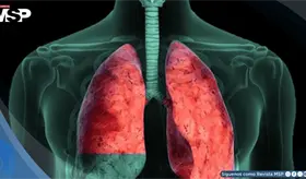 Derrame pleural: De evoluci&oacute;n progresiva en paciente adulto con disnea y dolor tor&aacute;cico
