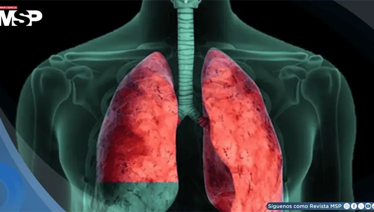 Derrame pleural: De evolución progresiva en paciente adulto con disnea y dolor torácico Derrame pleural: De evolución progresiva en paciente adulto con disnea y dolor torácico