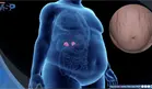 Enfermedad de Cushing, trastorno hormonal causado por un tumor en la hip&oacute;fisis