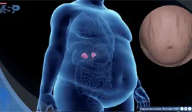 Enfermedad de Cushing, trastorno hormonal causado por un tumor en la hip&oacute;fisis