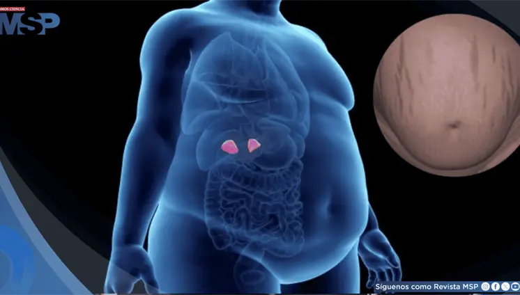 Enfermedad de Cushing, trastorno hormonal causado por un tumor en la hipófisis Enfermedad de Cushing, trastorno hormonal causado por un tumor en la hipófisis