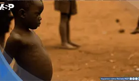 Manifestaciones cl&iacute;nicas y manejo nutricional de un paciente pedi&aacute;trico con Kwashiorkor