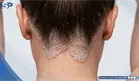 Psoriasis: cuando la enfermedad tambi&eacute;n cambia la forma en que el paciente se ve a s&iacute; mismo