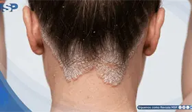 Psoriasis: cuando la enfermedad tambi&eacute;n cambia la forma en que el paciente se ve a s&iacute; mismo