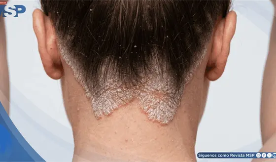 Psoriasis: cuando la enfermedad tambi&eacute;n cambia la forma en que el paciente se ve a s&iacute; mismo
