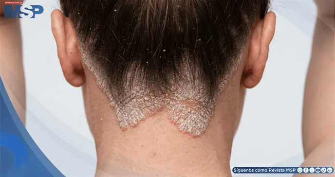Psoriasis: cuando la enfermedad tambi&eacute;n cambia la forma en que el paciente se ve a s&iacute; mismo