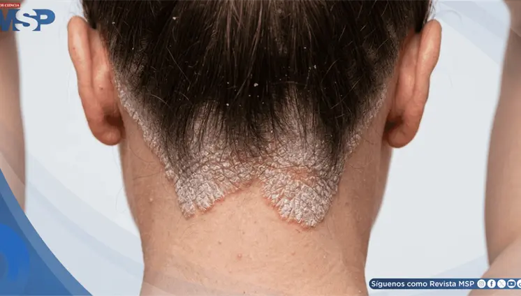 Psoriasis: cuando la enfermedad también cambia la forma en que el paciente se ve a sí mismo Psoriasis: cuando la enfermedad también cambia la forma en que el paciente se ve a sí mismo