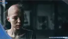 La alopecia prematura en j&oacute;venes se vincula con alteraciones metab&oacute;licas