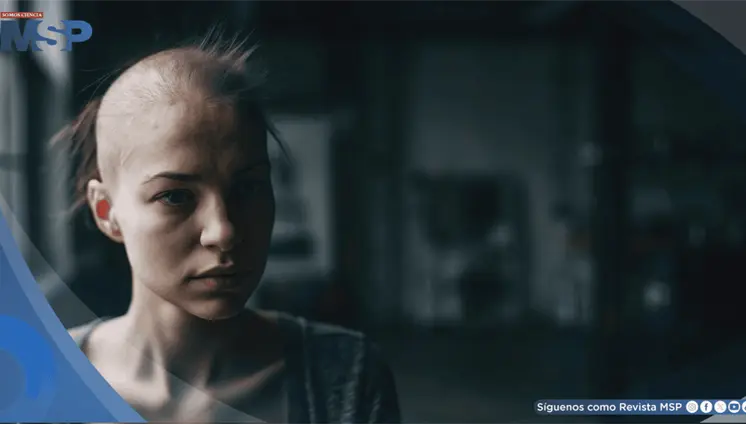 La alopecia prematura en j&oacute;venes se vincula con alteraciones metab&oacute;licas