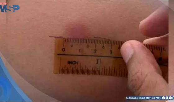 Emiten Orden Administrativa por escasez de tuberculina e impacto en certificados de salud