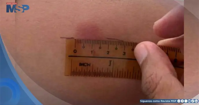 Emiten Orden Administrativa por escasez de tuberculina e impacto en certificados de salud