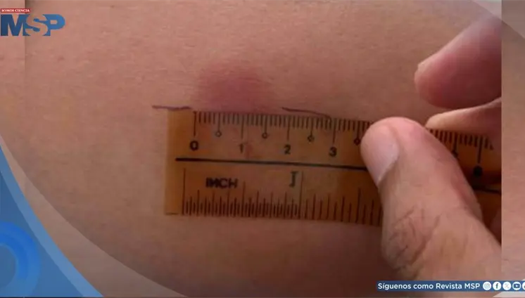 Emiten Orden Administrativa por escasez de tuberculina e impacto en certificados de salud