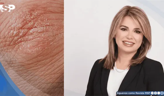 La psoriasis no es contagiosa: el estigma que persiste pese a los avances en su tratamiento