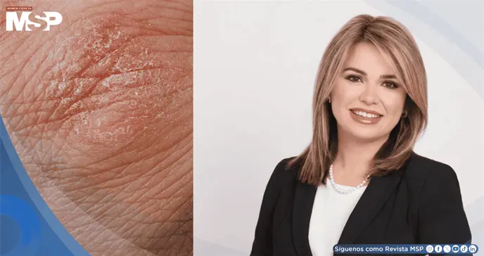 La psoriasis no es contagiosa: el estigma que persiste pese a los avances en su tratamiento