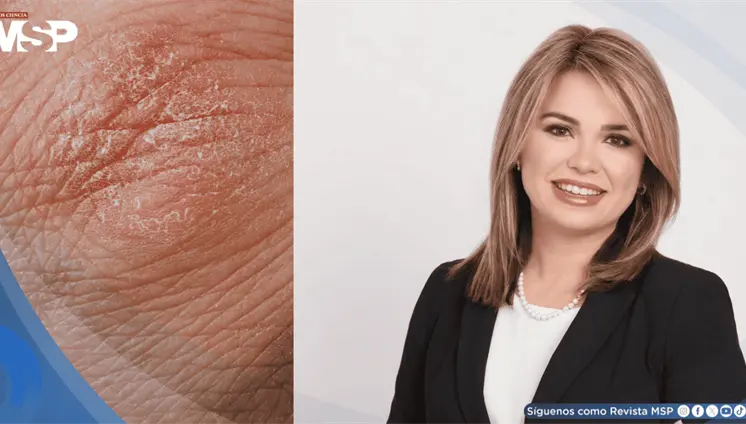 La psoriasis no es contagiosa: el estigma que persiste pese a los avances en su tratamiento La psoriasis no es contagiosa: el estigma que persiste pese a los avances en su tratamiento